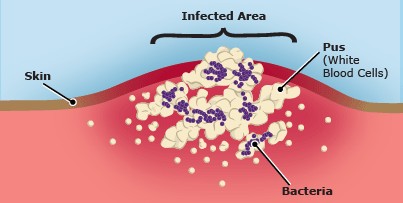 infected folliculitis #11