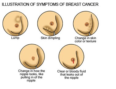 Breast Cancer