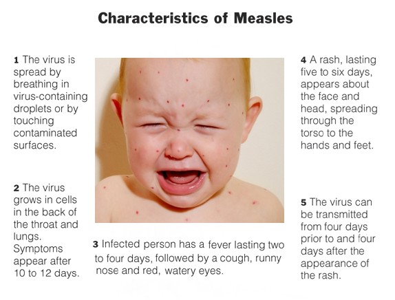 Measles