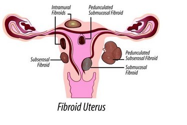 Fibroids