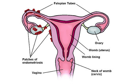 Endometriosis