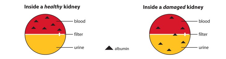 Albumin in Kidneys