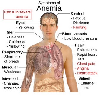 ANEMIA: SYMPTOMS