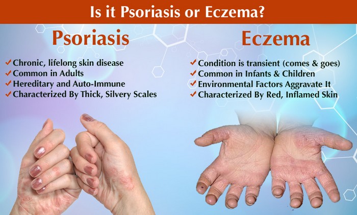 eczema vs psoriasis