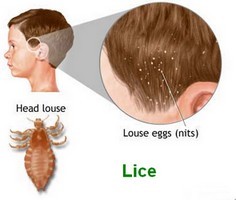 Lice