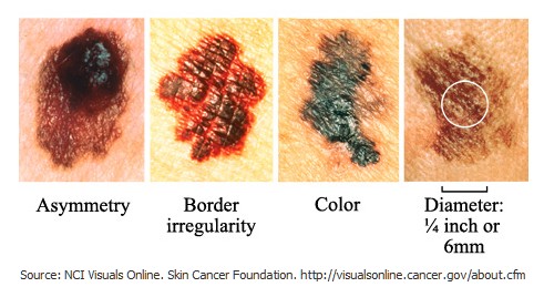 Skin Cancer